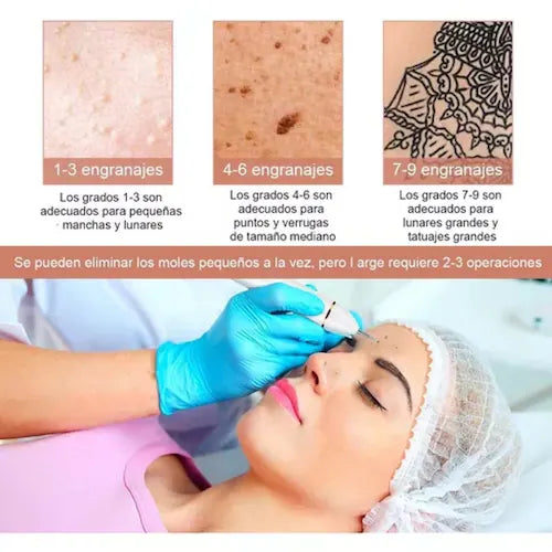Pluma Quita Verrugas, Removedor De Verrugas 🎁¡SUPER PROMOCIÓN!🎁