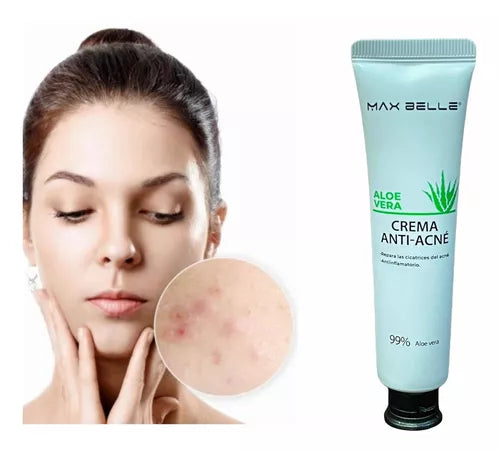Crema Anti-acne De Aloe Vera (Compra 1 y Obtén 1 GRATIS!)