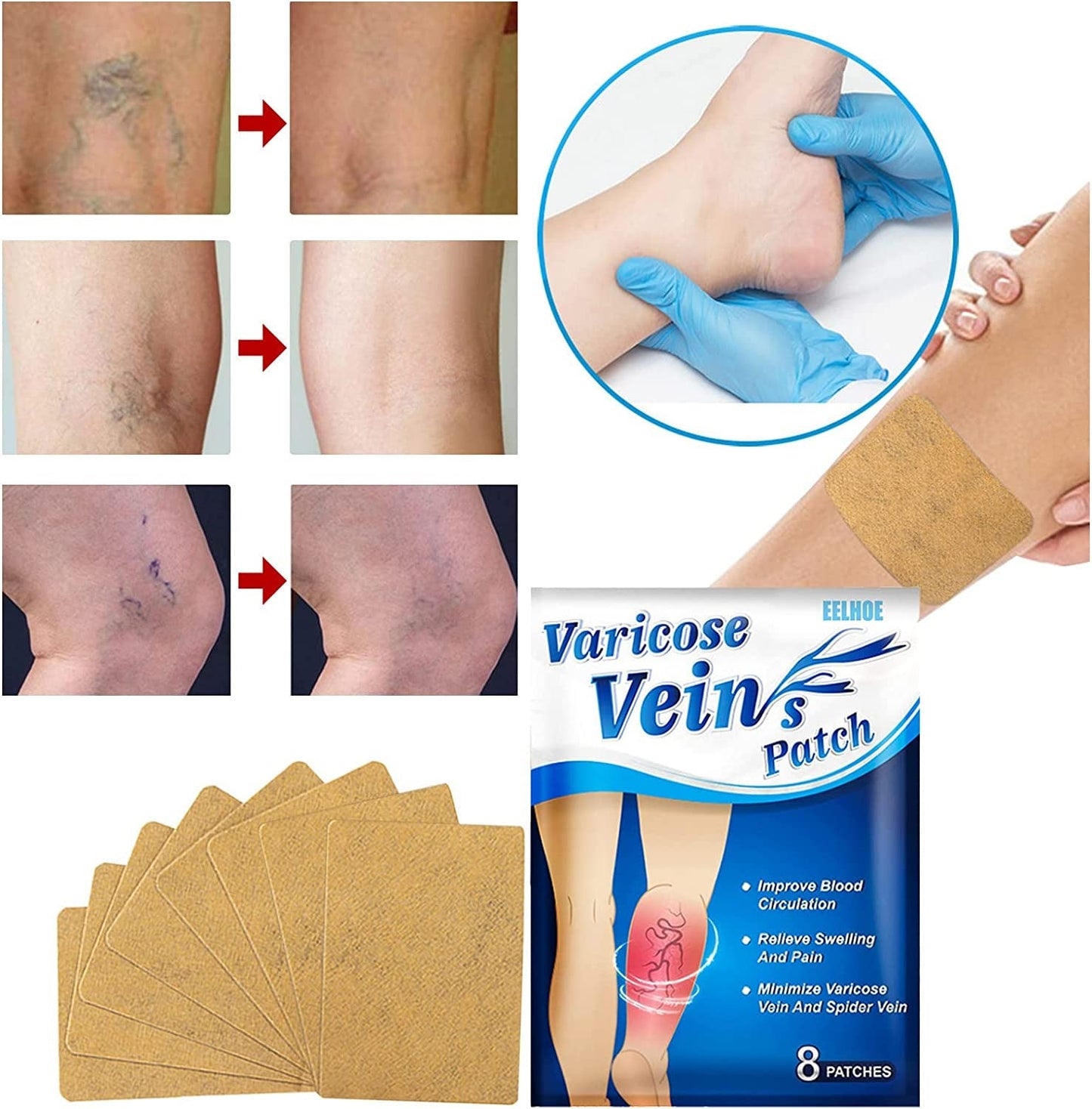 Parches Anti Varices, Flebitis Y Vasculitis