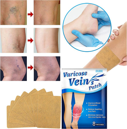 Parches Anti Varices, Flebitis Y Vasculitis