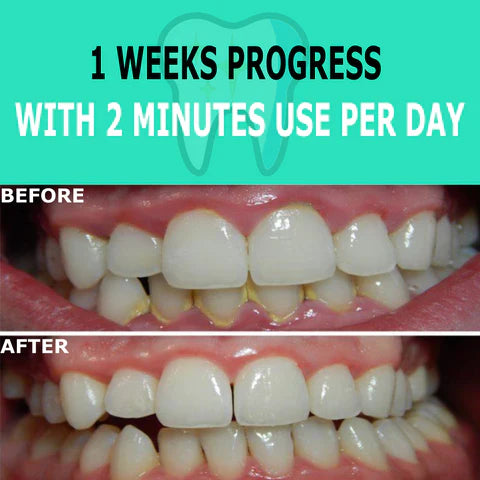 Limpiador Dental Ultrasónico